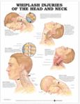 Whiplash Injuries of the Head and Neck. 20X26 Laminated Chart.